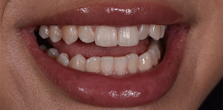 Pembe Estetik Öncesi