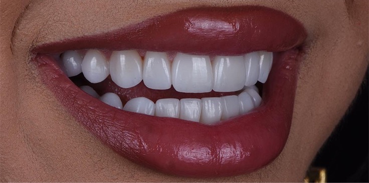 Pembe Estetik Sonrası