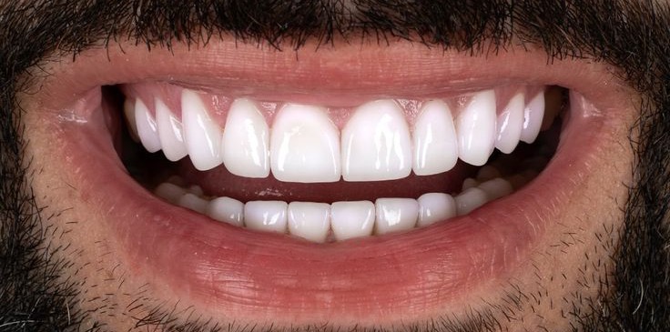 Gülüş Tasarımı Sonrası