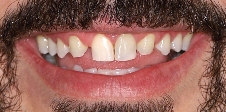 Aralıklı Diş Tedavisi Öncesi