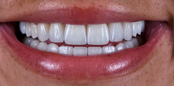 Laminate Veneer Sonrası